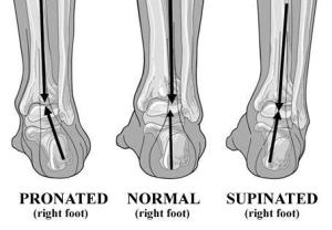 Pronated Supinated diagramoffeet